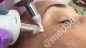 Микротоковая терапия для лица (Accura Испания)