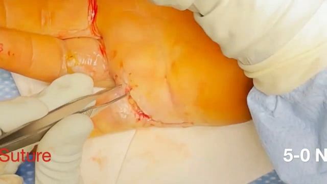 Right Hand Revision Wound Closure смотреть онлайн