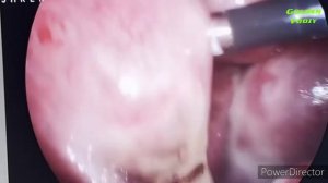 Бачадон тугунли  миомаси. Миоматоз тугунлар энуклеацияси. (Bachadon tugunli miomasi)