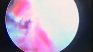 Поврежденный венозный клапан-(350p25).mp4