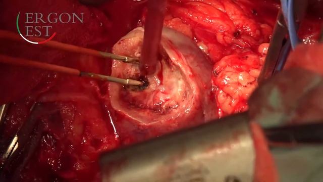 Открытая резекция почки с примененим шовного материала ERGON EST смотреть онлайн
