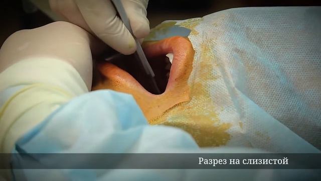 Удаление комков Биша смотреть онлайн