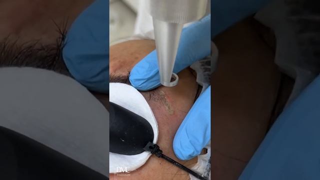 Как выглядят брови после удаления старого татуажа смотреть онлайн