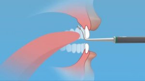 Логопед постановка звука Л импортным зондом