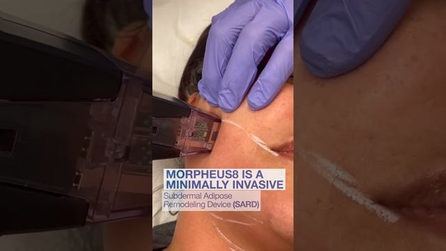 Morpheus8 Skin Tightening with Dr. Zuri in Miami | Zuri Plastic Surgery