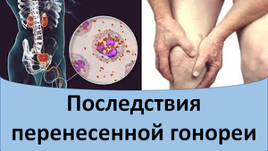 Последствия перенесенной гонореи