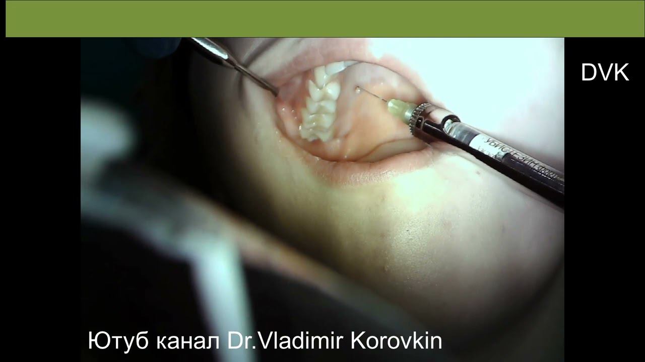 Infiltration anaesthesia for treatment 14 15 teeth.