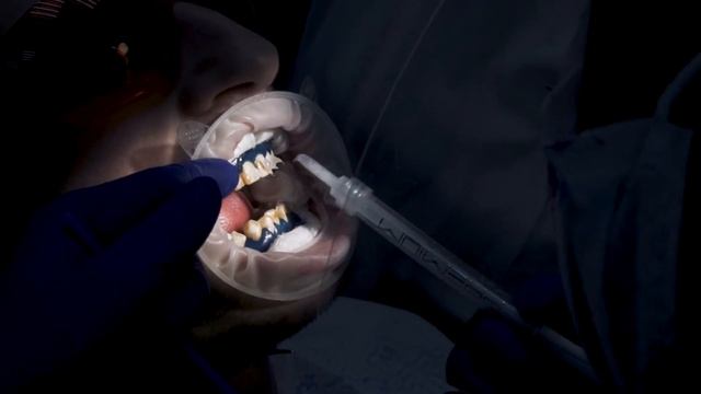 Как работает отбеливание зубов смотреть онлайн