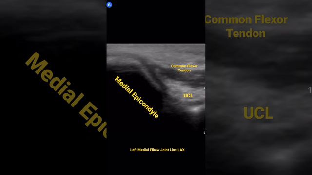 Medial Epicondyle Diagnostic Ultrasound - UCL, common flexor tendon смотреть онлайн