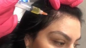 PRP Injections For Thinning hair and eyebrows