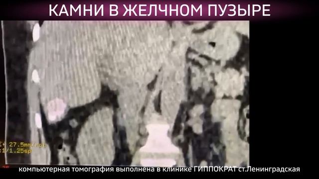 Компьютерная томография в станице Ленинградской. Диагностика камней в желчном пузыре