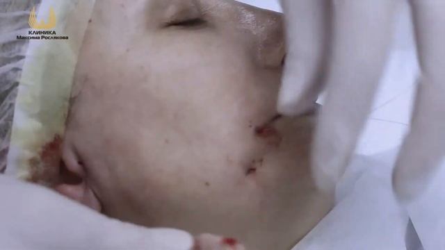Нитевая подтяжка хирургическими нитями.