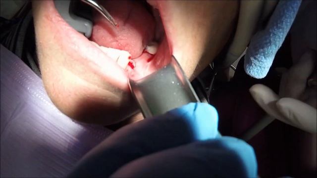 Xpanders™ | 2 bicuspids - Dental Elevator Tool for Socket Expansion - ArtCraft Dental, Inc смотреть онлайн