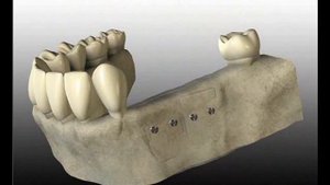 Хирургия  Инплантология  Остеопластика