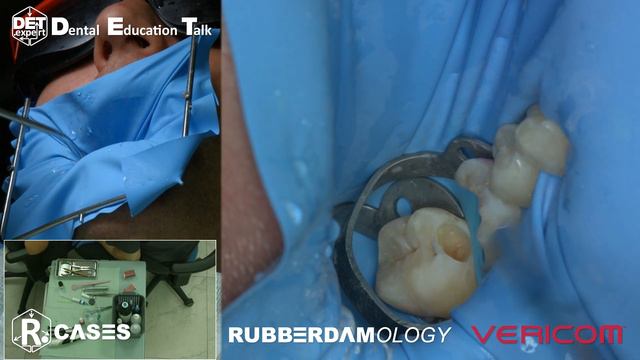 Травление тканей зуба #Rubberdamology #Vericom #Etching все кейсы ALL 14 Cases #8kdcv #8K смотреть онлайн