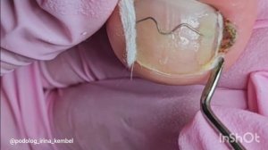 Система Unibrace