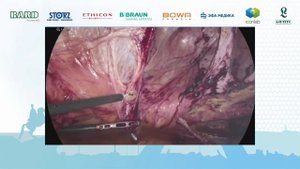 В. Бурдаков Е-TEP RS с подкожным эндоскопическим закрытием диастаза прямых мышц живота.