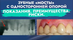 Мостовидные протезы с односторонней опорой -  Консольные протезы.