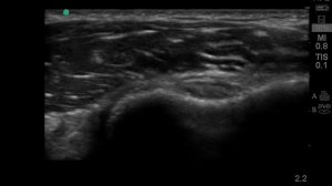 Anisotropy of the long head of biceps on ultrasound