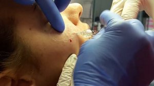 АирисКом: обучение применение филлеров для УВЕЛИЧЕНИЕ СКУЛ.