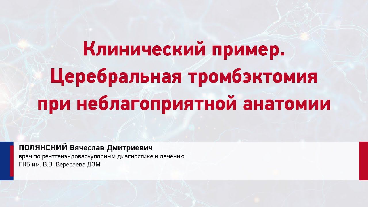 Полянский В.Д. Клинический пример. Церебральная тромбэктомия при неблагоприятной анатомии