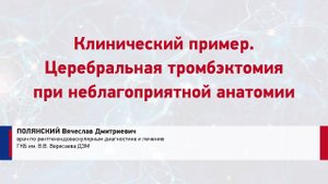 Полянский В.Д. Клинический пример. Церебральная тромбэктомия при неблагоприятной анатомии