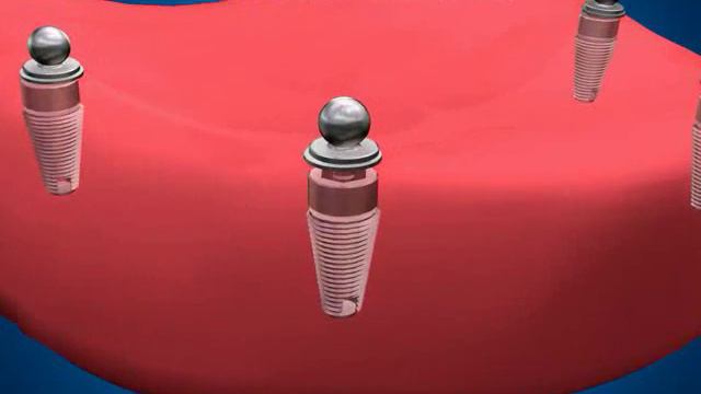 Полный сьемный на атачмене(на замках) смотреть онлайн