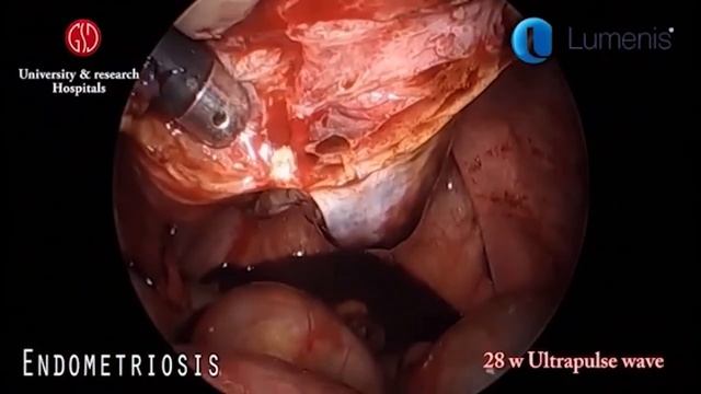 CO2-лазер со "свободным лучом" в эндоскопической гинекологии смотреть онлайн