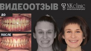 Исправление прикуса после перелома челюсти