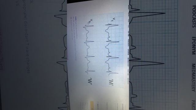 Rbbb pattern