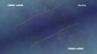 Roche in Spinal Muscular Atrophy making a difference for families смотреть онлайн