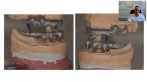 Концепция изготовления полносъемных протезов с телескопической фиксацией SynCone.