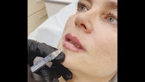 Коррекция губ препаратом Stylage Lips клиника ДиалДент Москва