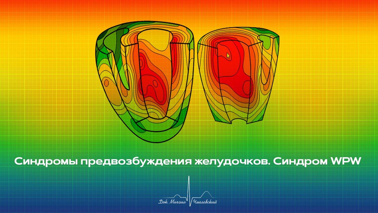 Синдромы предвозбуждения желудочков. Синдром WPW