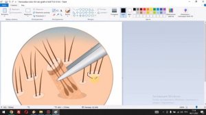 Пример пересадки волос на голове