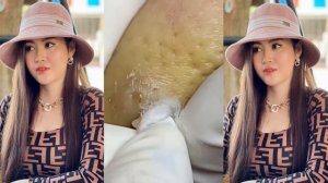 Best bleckheads,Blackheads Removal,Blackhead Extractions, Выдавливание черных точек прыщей 2022