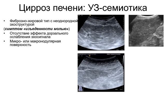 Цирроз печени