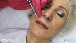 Увеличение губ Juvederm Volift 1ml (Ювидерм Волифт 1 мл)
