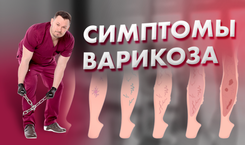 Симптомы варикоза. Как определить варикозное расширение вен?