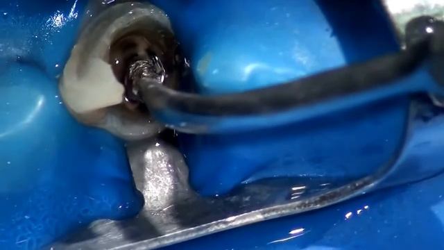 Извлечение анкерного штифта из корневого канала смотреть онлайн