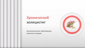 Хронический холецистит. Камни желчного пузыря. Лечение.