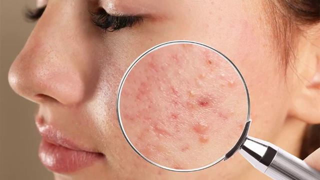 Как избавиться от прыщей навсегда в домашних условиях. смотреть онлайн
