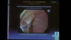 41 Параскевова АВ Клиническое наблюдение пациента с атрофическим аутоиммунным гастритом
