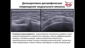 УЗИ менисков коленного сустава