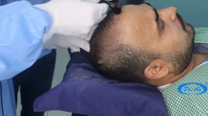 Микронидлингдермароллинг для восстановления роста волос. PRP-лечение с микронидлингом