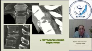 Травма позвоночника и спинного мозга Ермолаев ЮФ.mp4