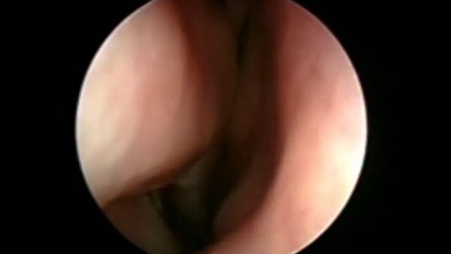 Аденоиды 2 3 степени в 30 лет.mp4 смотреть онлайн