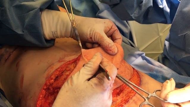 Mommy Makeover Live Surgery - Breast Augmentation And Tummy Tuck ( Abdominoplasty ) Phillip Chang M