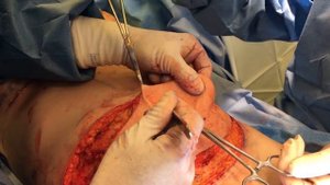 Mommy Makeover Live Surgery - breast augmentation and tummy tuck ( abdominoplasty ) Phillip Chang M