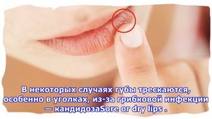 Почему трескаются губы и что с этим делать